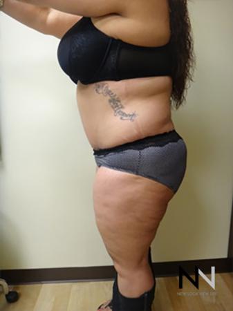 Abdominoplasty: Patient 11 - After Image 2