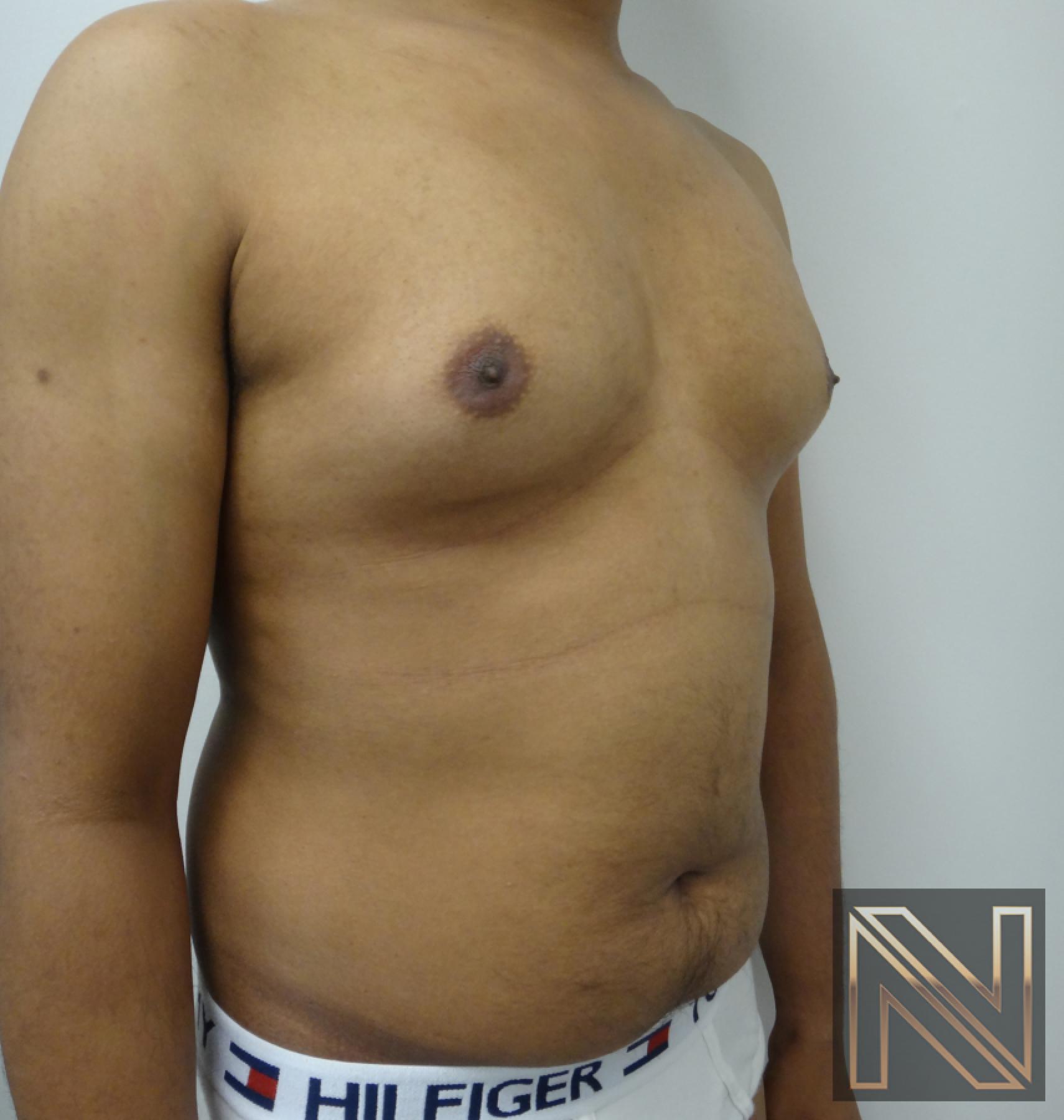 Gynecomastia: Patient 6 - Before and After 3
