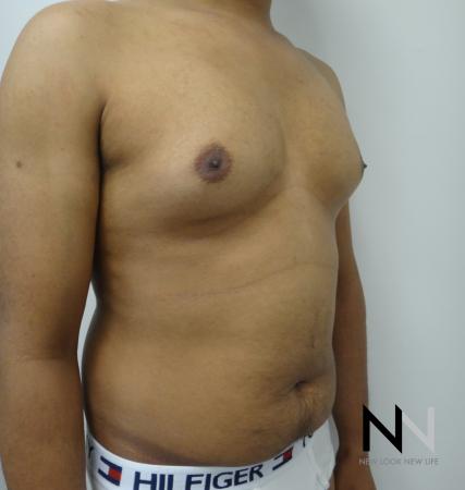 Gynecomastia: Patient 6 - Before and After Image 3