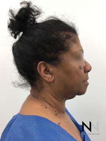 Facelift/Mini Facelift: Patient 7 - Before Image 2