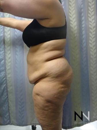 Abdominoplasty: Patient 14 - Before Image 2