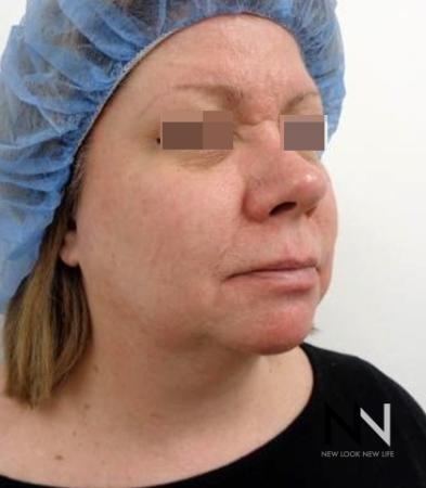 Fractional Resurfacing: Patient 2 - After Image 2