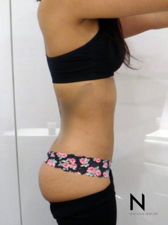 Liposuction: Patient 9 - After Image 2