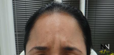 Dysport® : Patient 8 - Before Image 1