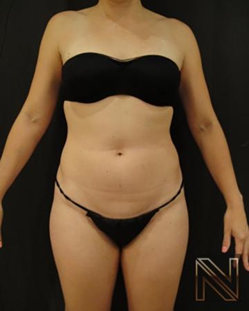 Liposuction: Patient 8 - Before 