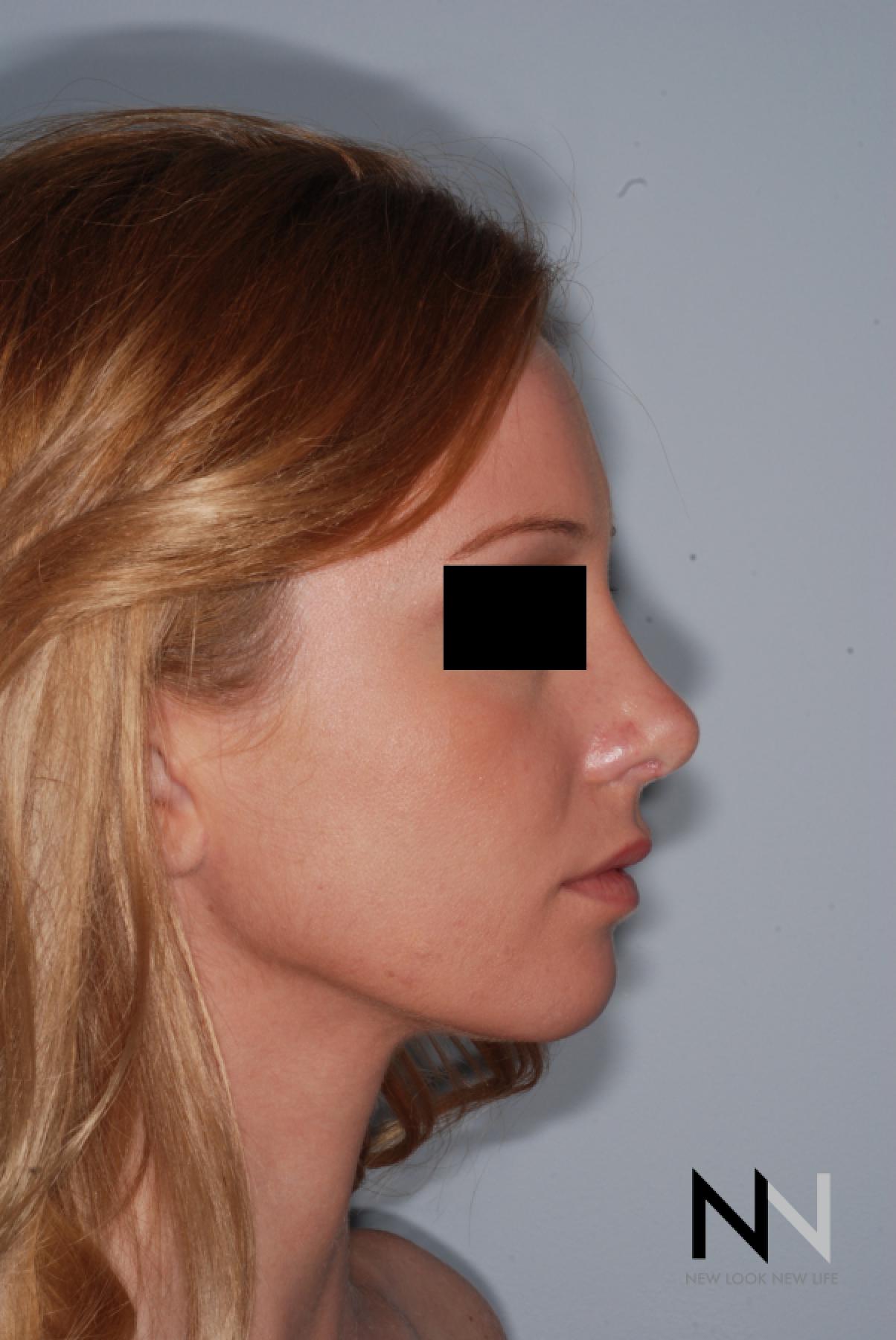 Rhinoplasty: Patient 4 - After  