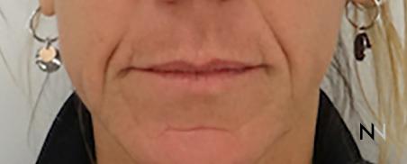 Fillers: Patient 6 - Before 