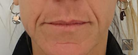 Fillers: Patient 6 - Before 