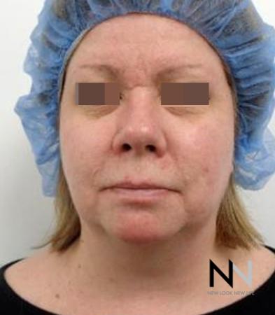 Fractional Resurfacing: Patient 2 - After Image 5