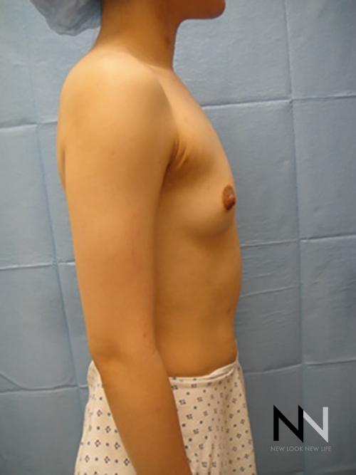 Breast Augmentation: Patient 4 - Before and After 5