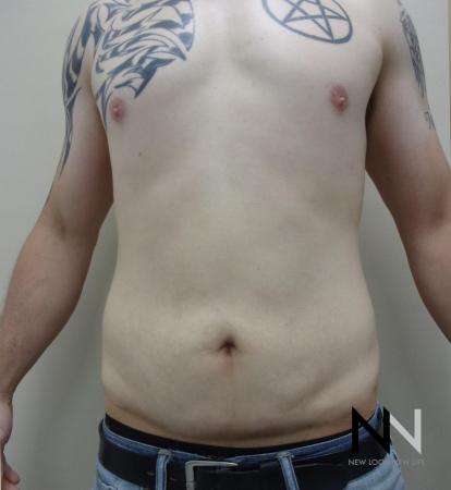 Mini Tummy Tuck: Patient 2 - After Image 1