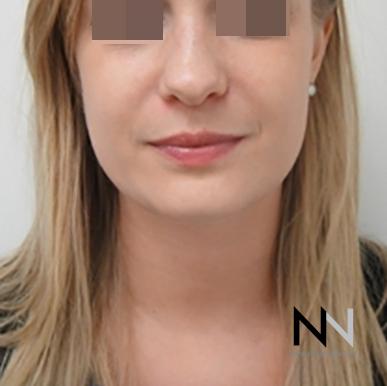 Liposuction: Patient 1 - After Image 1