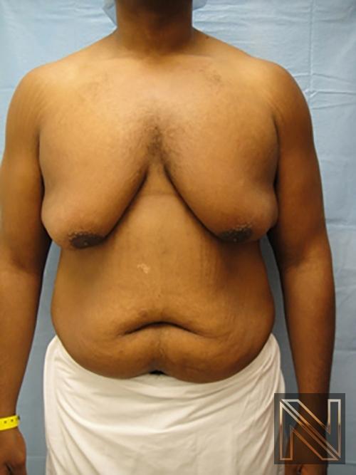 Gynecomastia: Patient 1 - Before 1