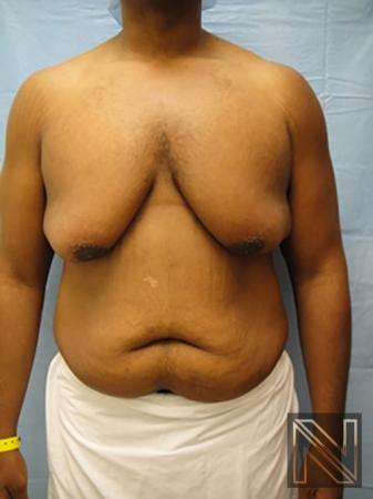 Gynecomastia: Patient 1 - Before 