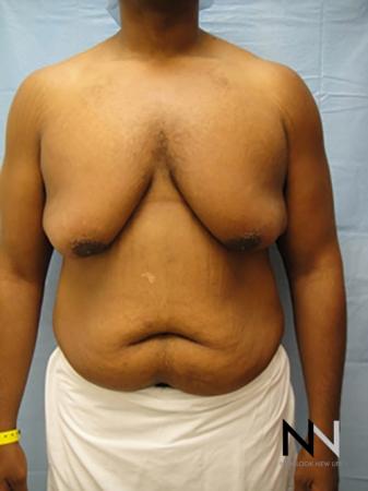 Gynecomastia: Patient 1 - Before Image 1