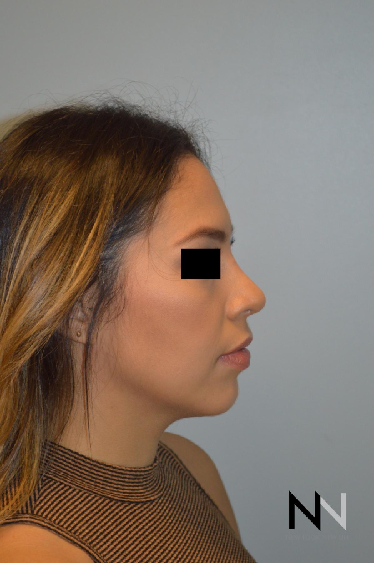 Rhinoplasty: Patient 6 - After 3