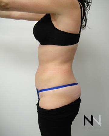 Liposuction: Patient 8 - After Image 2