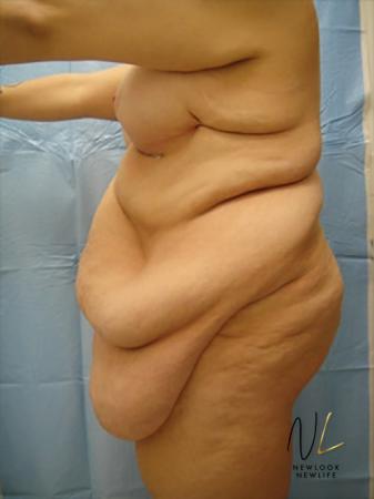 Abdominoplasty: Patient 16 - Before Image 2