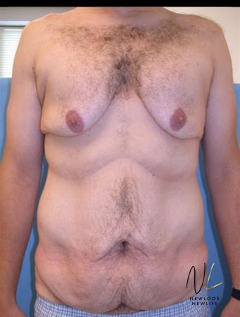 Abdominoplasty: Patient 32 - Before 1