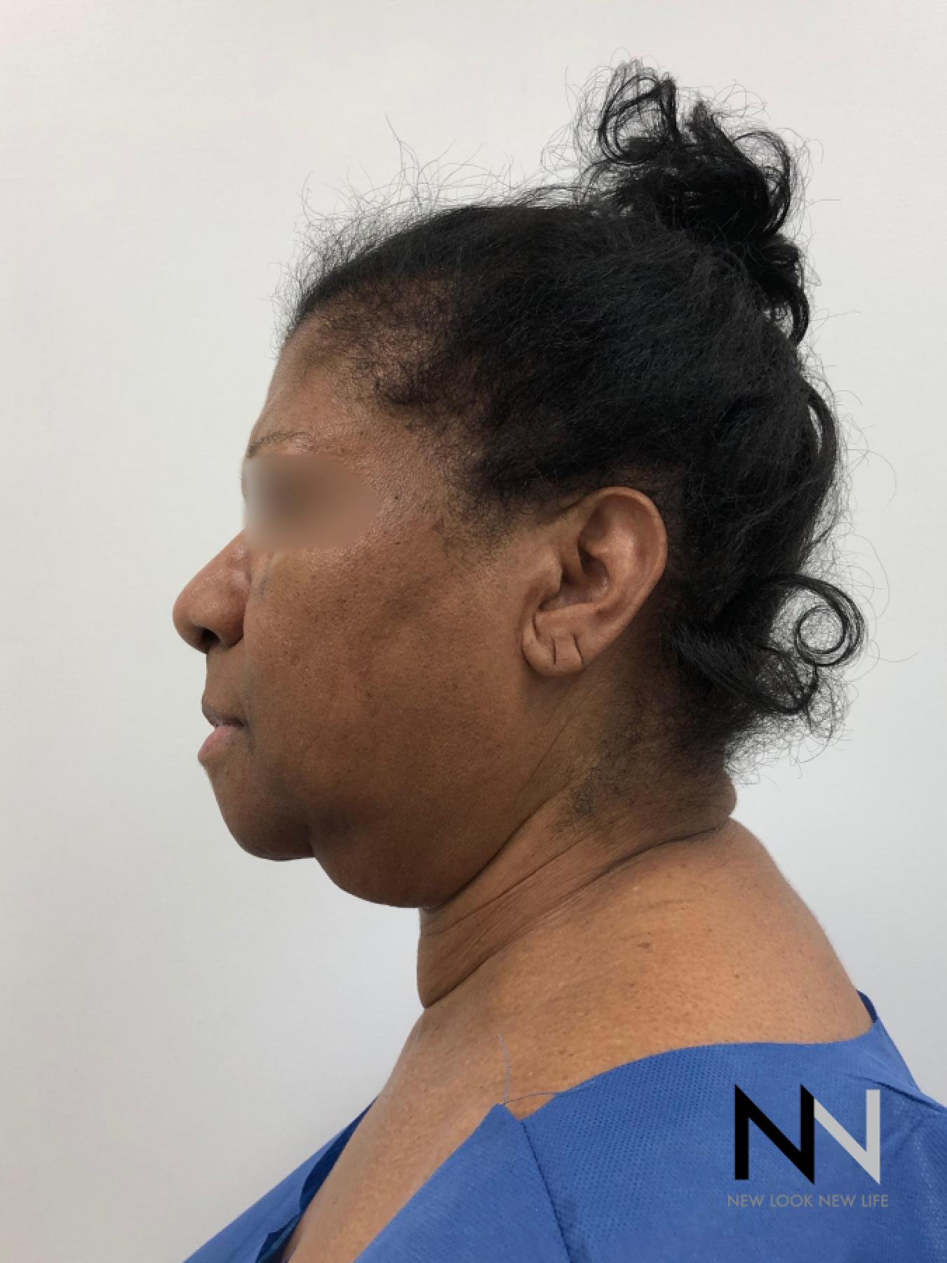 Facelift/Mini Facelift: Patient 7 - Before 1