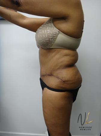 Abdominoplasty: Patient 8 - After Image 2