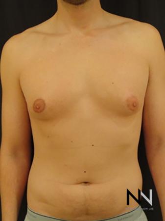 Gynecomastia: Patient 4 - Before Image 1