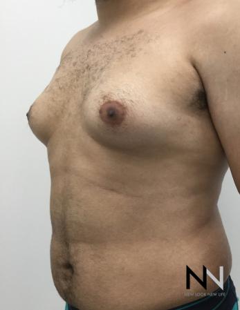 Gynecomastia: Patient 10 - Before and After Image 5