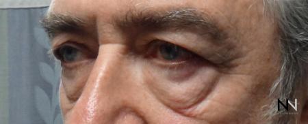 Blepharoplasty: Patient 7 - Before Image 1