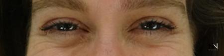 Dysport® : Patient 11 - Before Image 1