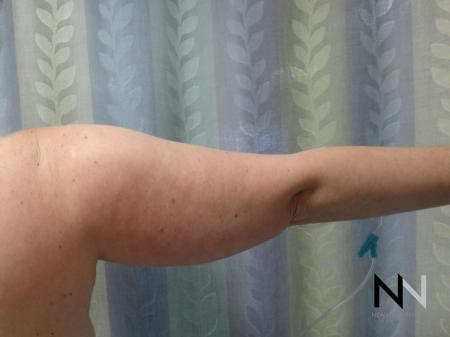 Liposuction: Patient 24 - Before and After Image 4