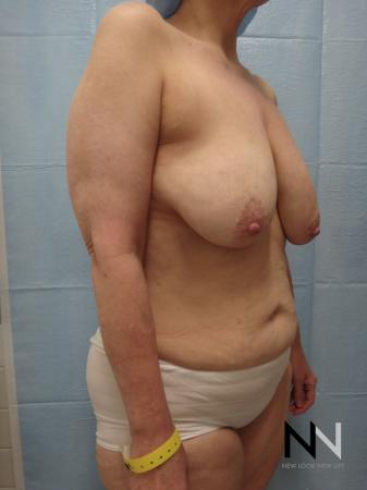 Breast Lift: Patient 3 - Before Image 2