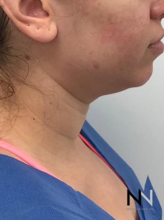 Liposuction: Patient 2 - Before Image 1