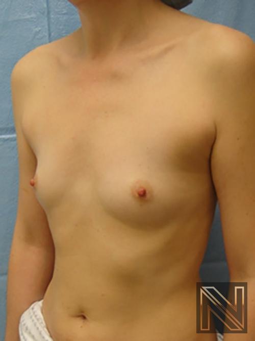 Breast Augmentation: Patient 5 - Before 2