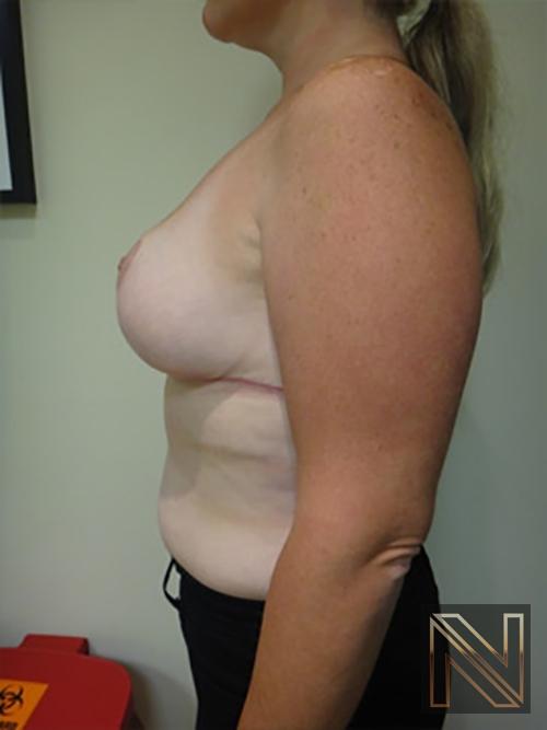 Breast Reduction: Patient 9 - After 4