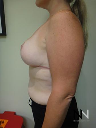 Breast Reduction: Patient 9 - After Image 4