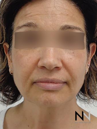 Halo™: Patient 1 - After Image 1