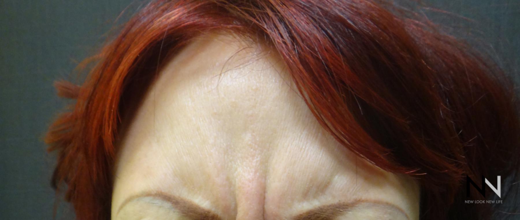 BOTOX® Cosmetic: Patient 4 - Before 1