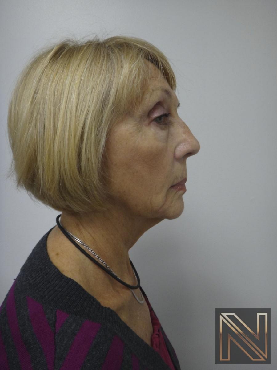Ultherapy®: Patient 2 - After 3