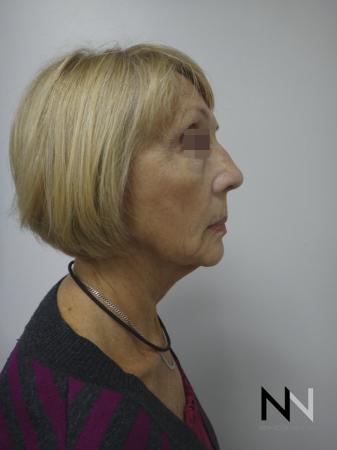 Ultherapy®: Patient 2 - After Image 3