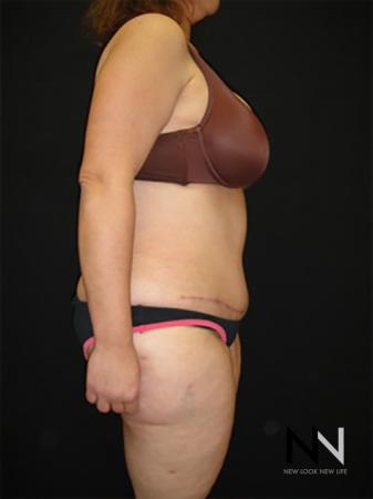 Abdominoplasty: Patient 19 - After 3