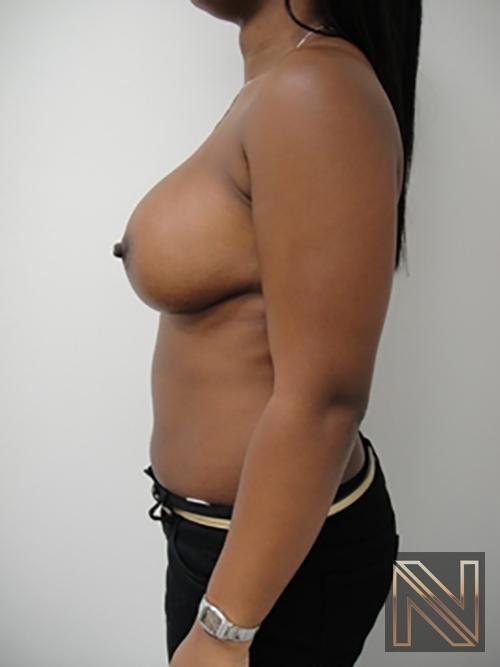 Breast Augmentation: Patient 12 - After 4