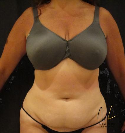Mini Tummy Tuck: Patient 6 - Before Image 1