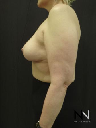 Breast Lift: Patient 3 - After Image 4