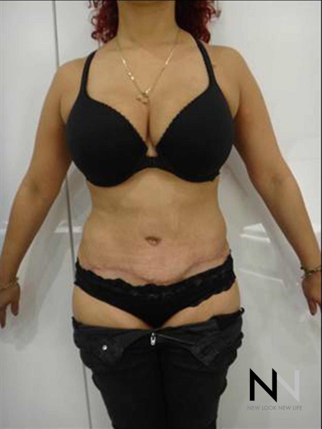 Abdominoplasty: Patient 25 - After 1