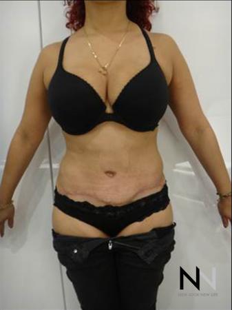 Abdominoplasty: Patient 25 - After Image 1