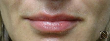 Fillers: Patient 5 - After  