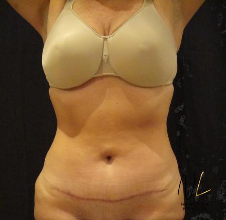 Mini Tummy Tuck: Patient 6 - After Image 1