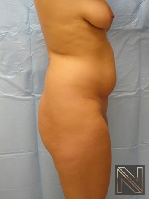 Butt Augmentation: Patient 1 - Before and After 2