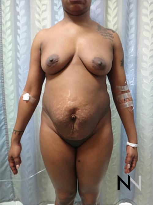 Abdominoplasty: Patient 13 - Before 1