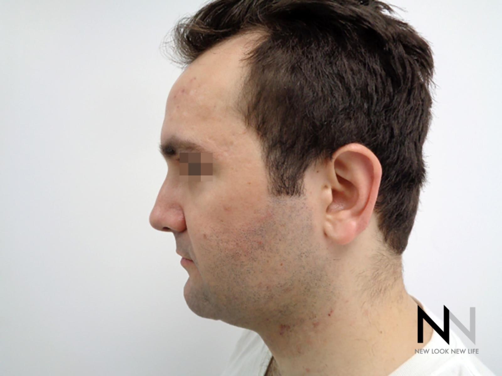 Laser Skin Resurfacing - Face: Patient 3 - Before 4